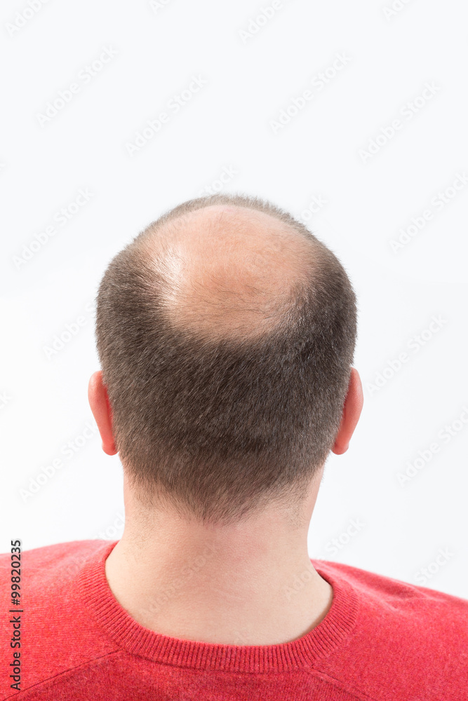 Obraz premium Chute de Cheveux Homme