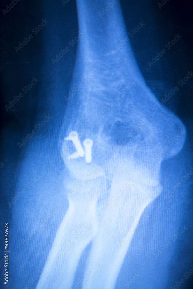 Surgical implant arm elbow xray test scan Stock Photo Adobe Stock