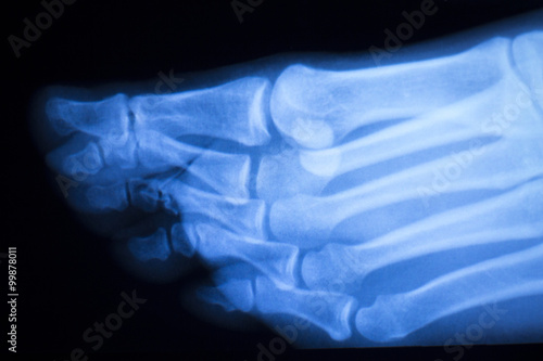 Foot and toes injury x-ray scan