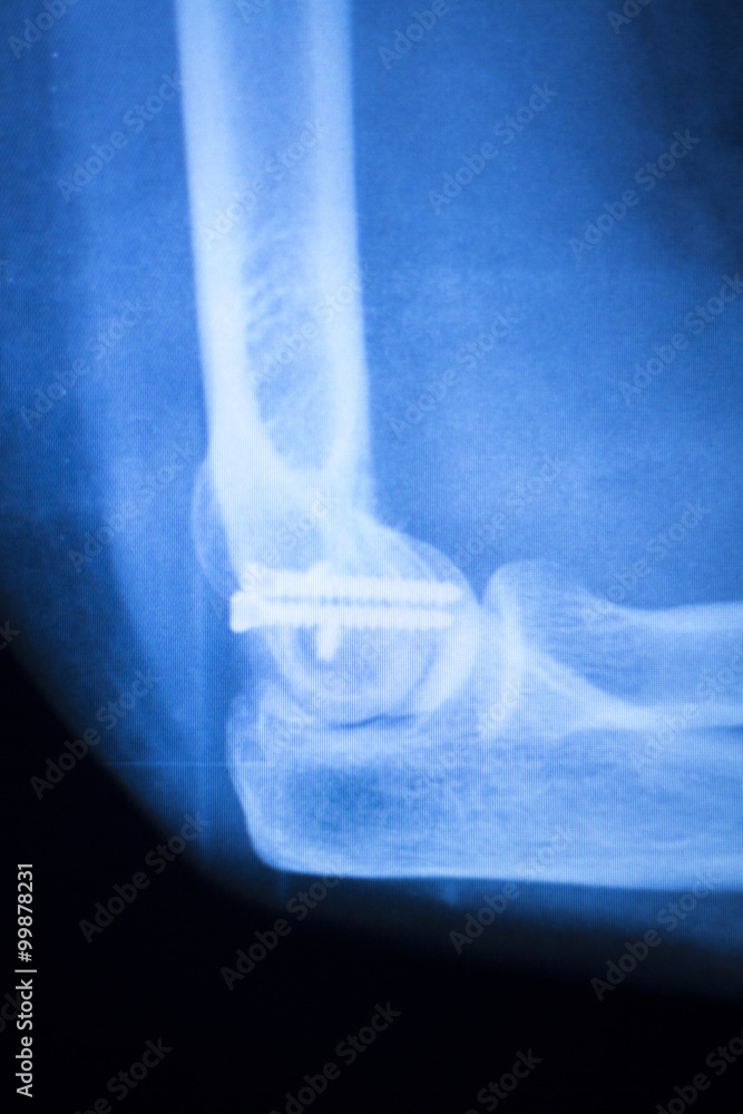 Surgical implant arm elbow xray test scan Stock Photo Adobe Stock