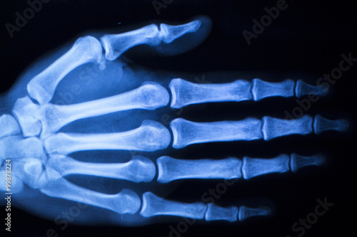 Hand finger thumb hospital xray scan