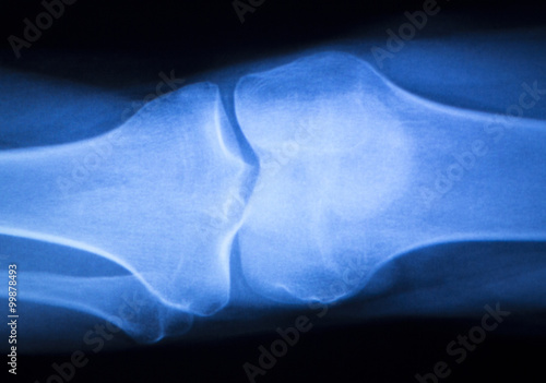 Canvas Print Knee joint meniscus x-ray test scan