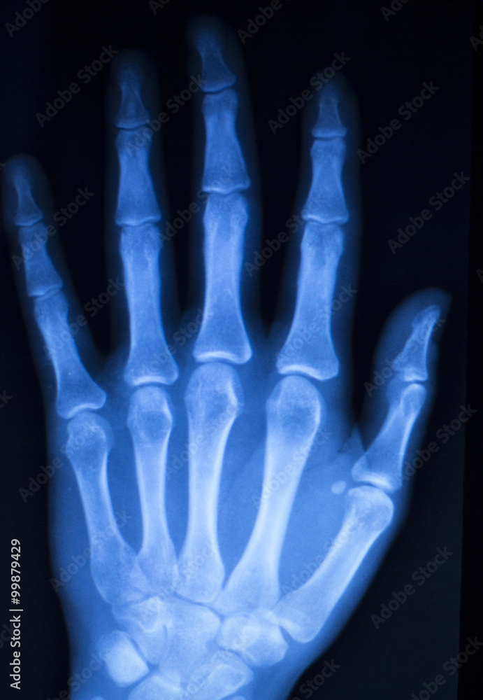 Hand finger thumb hospital xray scan Hand finger thumb hospital xray scan
