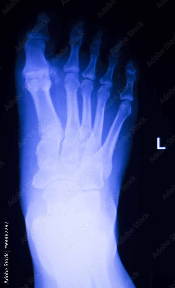 Foot and toes injury x-ray scan Foot and toes injury x-ray scan