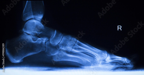 Valokuva Foot and toes injury x-ray scan
