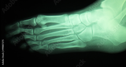 Foot and toes injury x-ray scan
