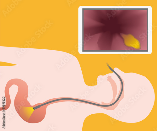 nasal endoscope, gastroscopy, vector illustration
