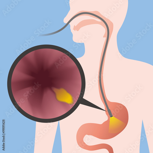nasal endoscope, gastroscopy, vector illustration