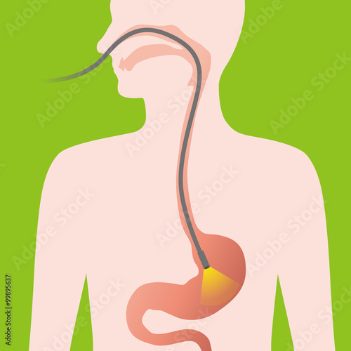 nasal endoscope, gastroscopy, vector illustration