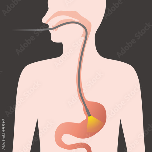 peroral endoscopy, endoscope, vector illustration