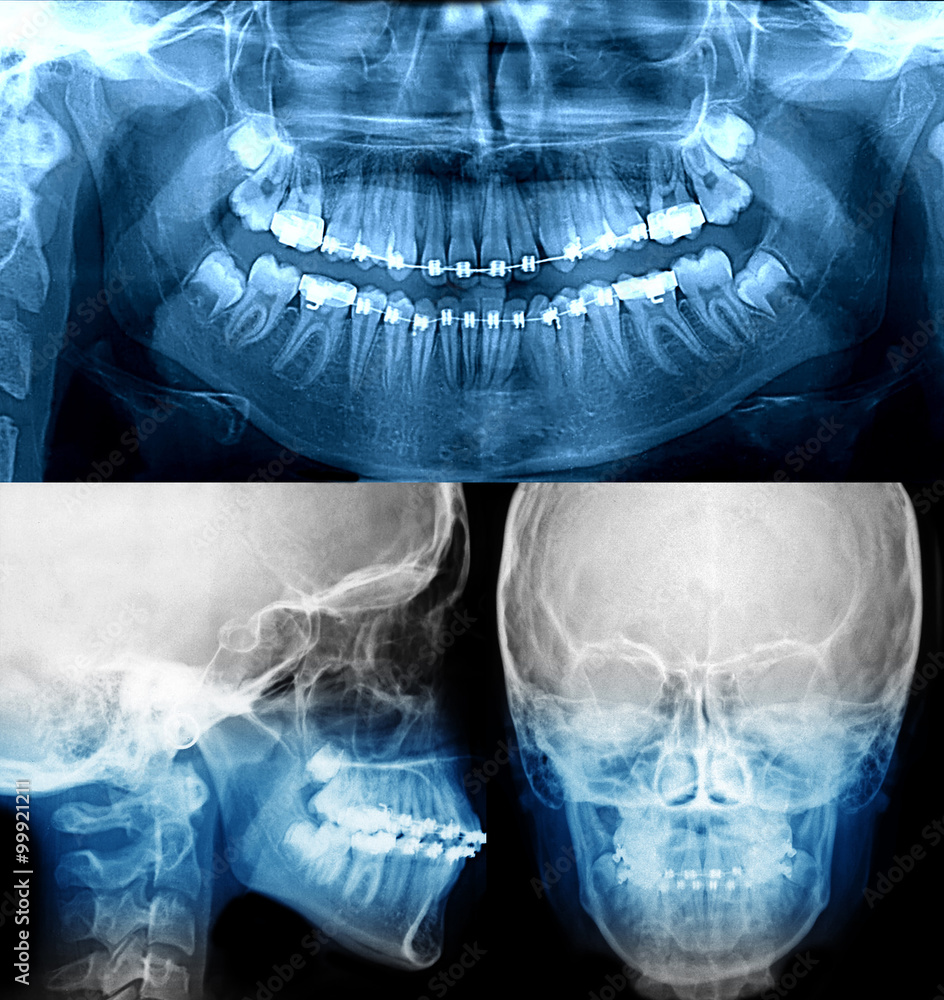 xray with dental braces, orthodontic treatment ilustración de Stock