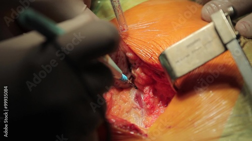 Slicing through flesh

Surgeon slicing the flesh to get to the muscle with electrosurgical scalpel (CU)