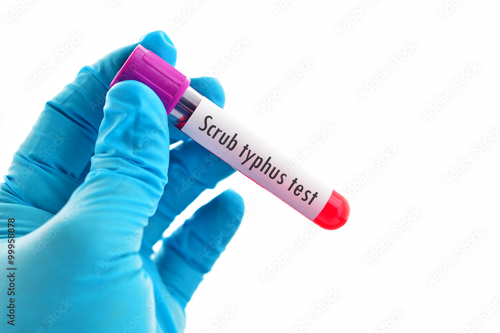 Obraz premium Blood sample for Scrub typhus test 