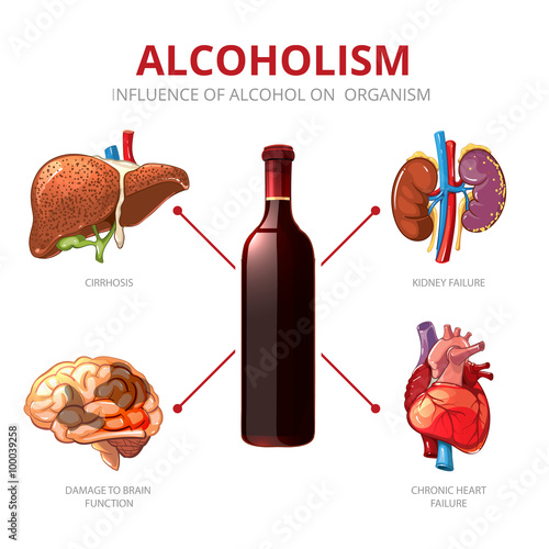 Long-term effects of alcohol. Organism function and brain damage, failure kidney illustration. Alcoholism vector infographic