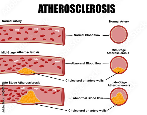 Atherosclerosis
