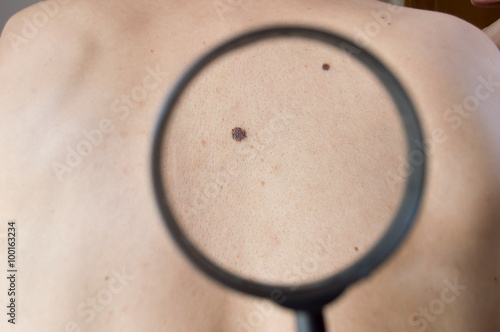 Quadro su tela checking melanoma on back of man