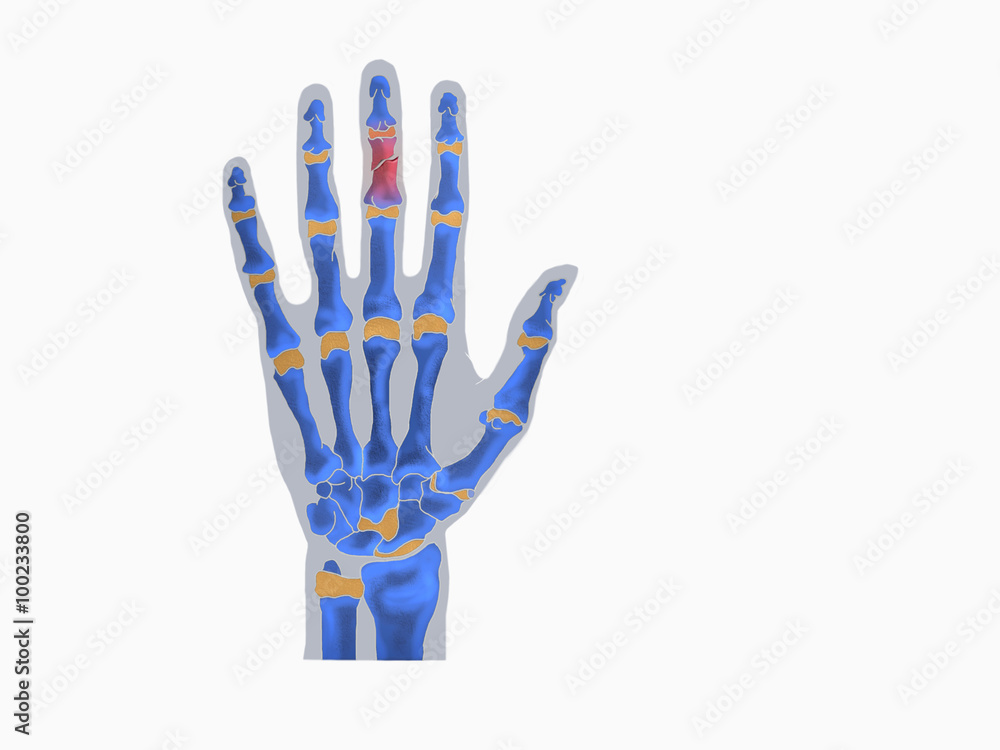 anatomie bruch mittelfinger anatomie bruch mittelfinger
