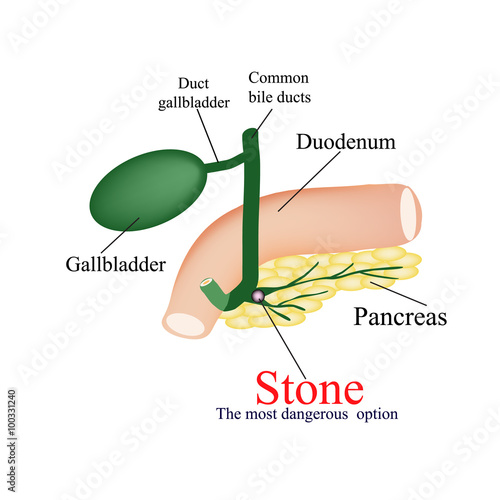 Stone pancreatic bile duct. The most dangerous rock. The gall bladder, duodenum, bile ducts. Vector illustration on isolated background