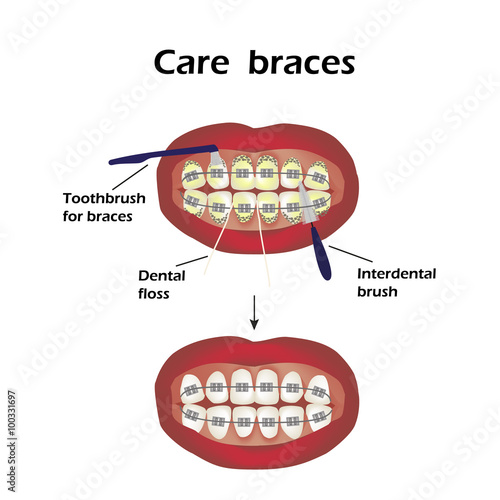 Care braces. Interdental brush teeth. Dental floss. Infographics. Vector illustration on isolated background