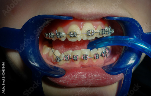 Patient in dental office with orthodontic brackets, elastics, bands during orthodontic treatment with dental fixed appliance photo