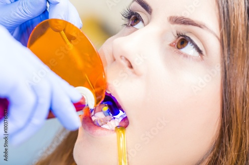 Dental filling procedure