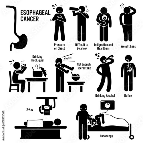 Esophageal Esophagus Throat Cancer Symptoms Causes Risk Factors Diagnosis Stick Figure Pictogram Icons