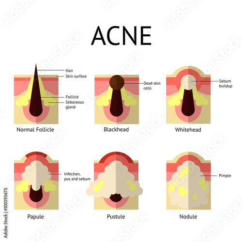 Types of acne pimples. Healthy skin, Whiteheads and Blackheads, Papules and Pustules in flat style.