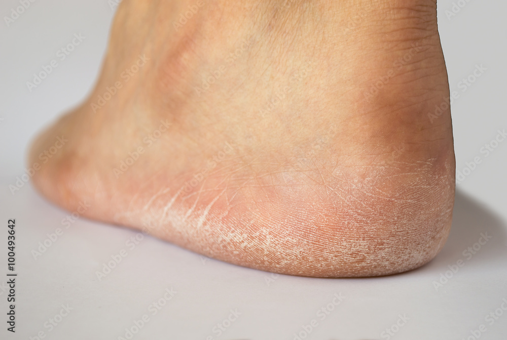 Naklejka premium heel cracked of foot
