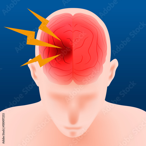 headache, cerebral hemorrhage, brain stroke, image illustration