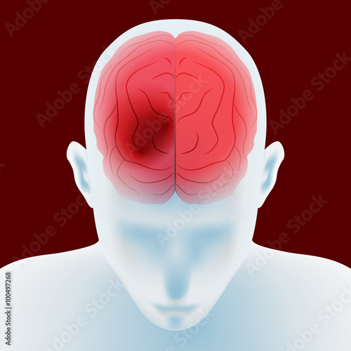 headache, cerebral hemorrhage, brain stroke, image illustration