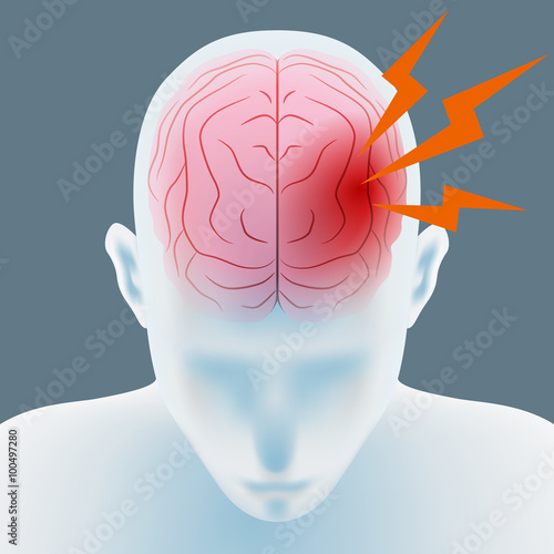 headache, cerebral hemorrhage, brain stroke, image illustration