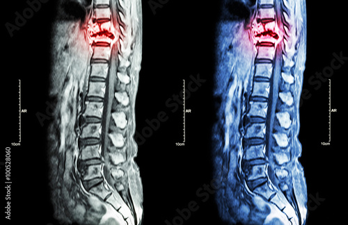 Spine metastasis ( cancer spread to thoracic spine ) ( MRI of thoracic and lumbar spine : show thoracic spine metastasis and compress spinal cord ( Myelopathy ) ) ( sagittal plane )