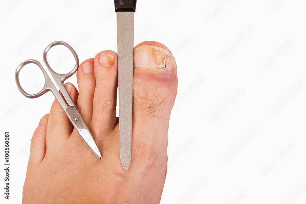 Foot with toenail fungus, scissors and file-isolated Foot with toenail fungus, scissors and file-isolated