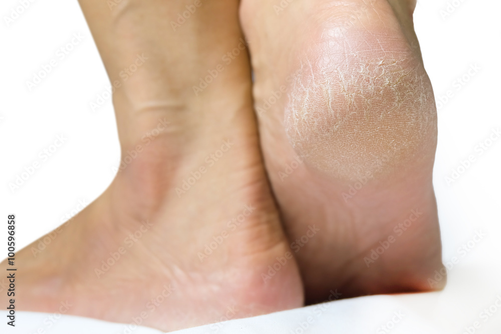 Women's feet dry On a white background Women's feet dry On a white background
