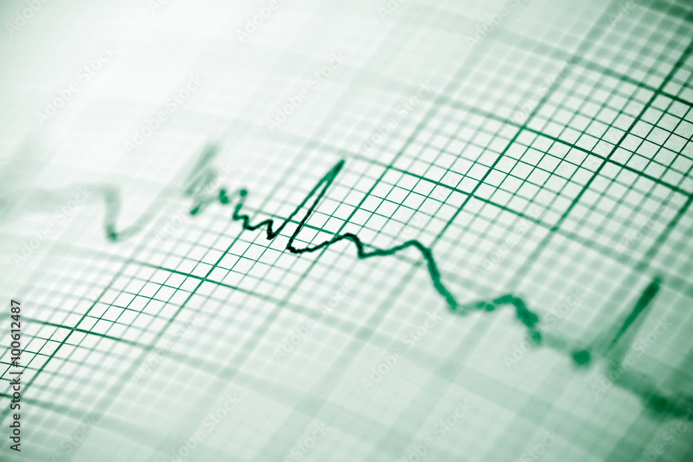 Electrocardiogram Electrocardiogram
