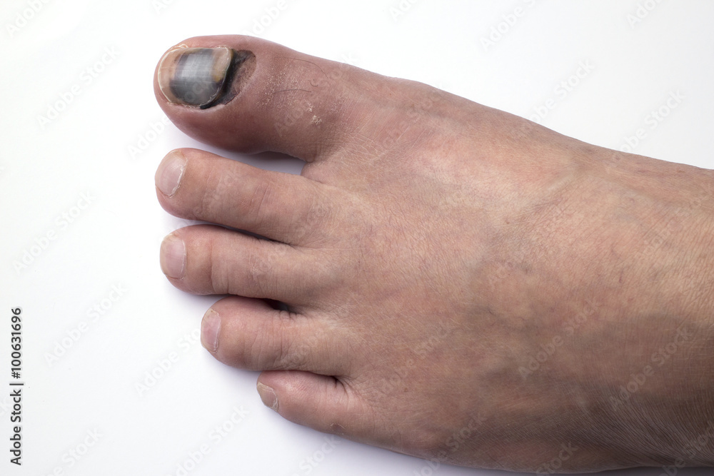 Fototapeta premium Phalanx fracture and bleeding under skin and nail