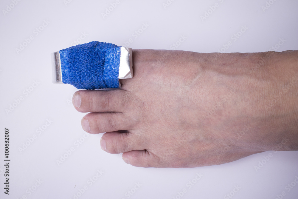 Fototapeta premium Phalanx fracture with splint and elastic gauze