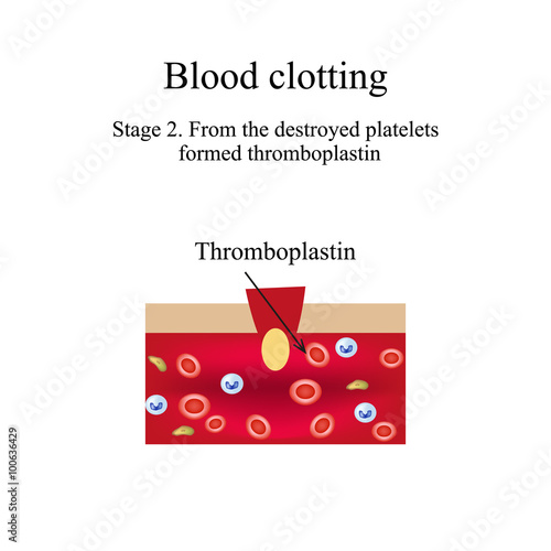 Blood clotting. Stage 2. Infographics. Vector illustration