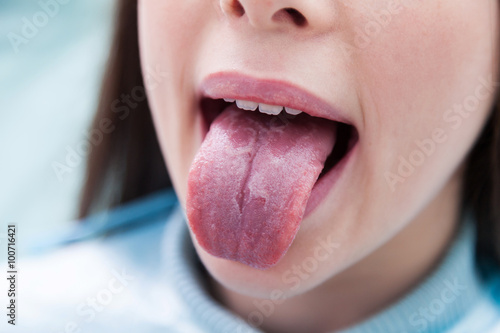 Geographic tongue