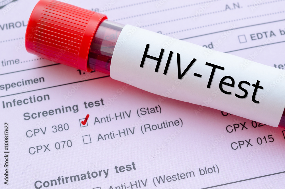 Obraz premium HIV infection screening test form.
