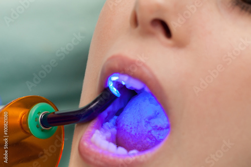 Dental obturation photo