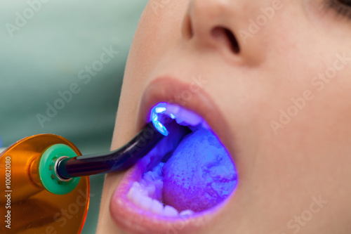 Dental obturation