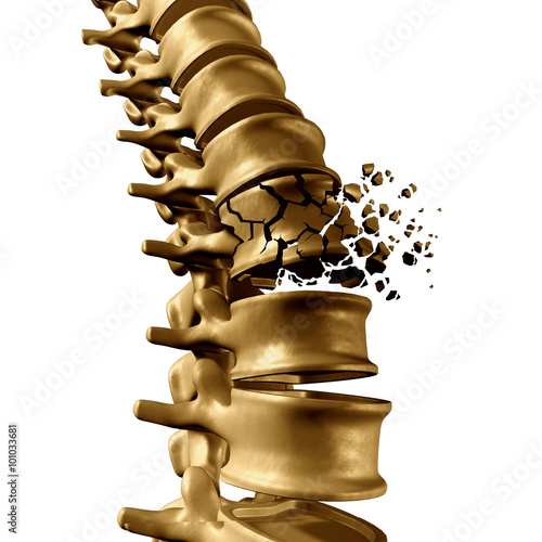 Obraz na plátne Spine Fracture
