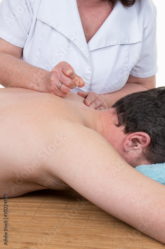 Therapist doing acupuncture to a man back
