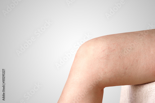 varicose veins in women