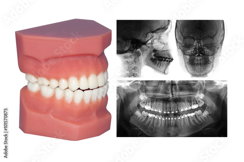 teeth model and cephalometric x-ray isolated on withe photo