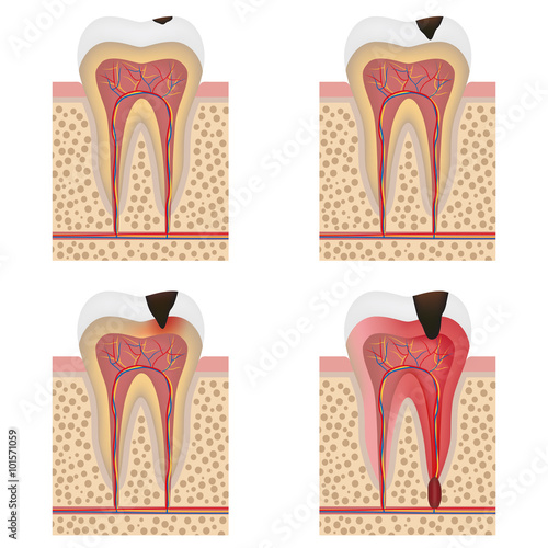 Development of dental caries illustration.