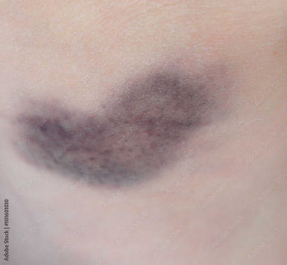 Fototapeta premium Bruise