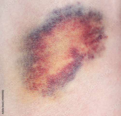 Bruise