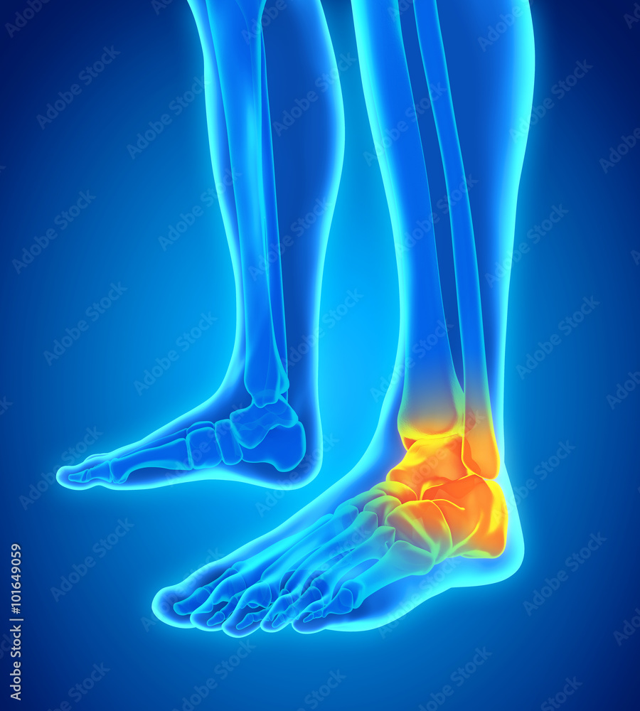 Painful Ankle Illustration